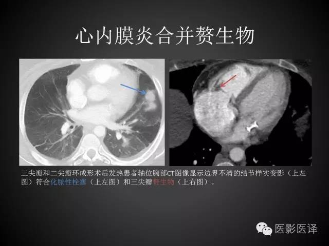 普通放射科医生需要了解的成人心脏瓣膜病知识 普通放射科医生需要了解的成人心脏瓣膜病知识
