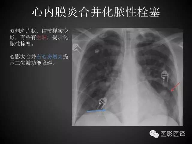 普通放射科医生需要了解的成人心脏瓣膜病知识 普通放射科医生需要了解的成人心脏瓣膜病知识