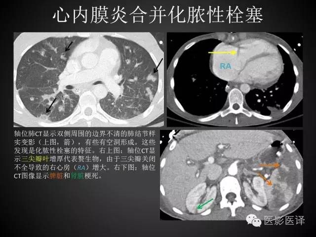 普通放射科医生需要了解的成人心脏瓣膜病知识 普通放射科医生需要了解的成人心脏瓣膜病知识