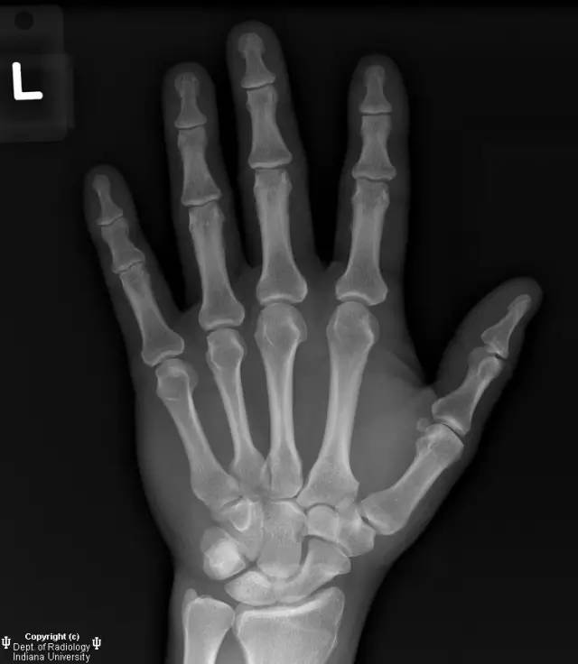 【病例】月骨缺血性坏死1例MR影像表现 【病例】月骨缺血性坏死1例MR影像表现