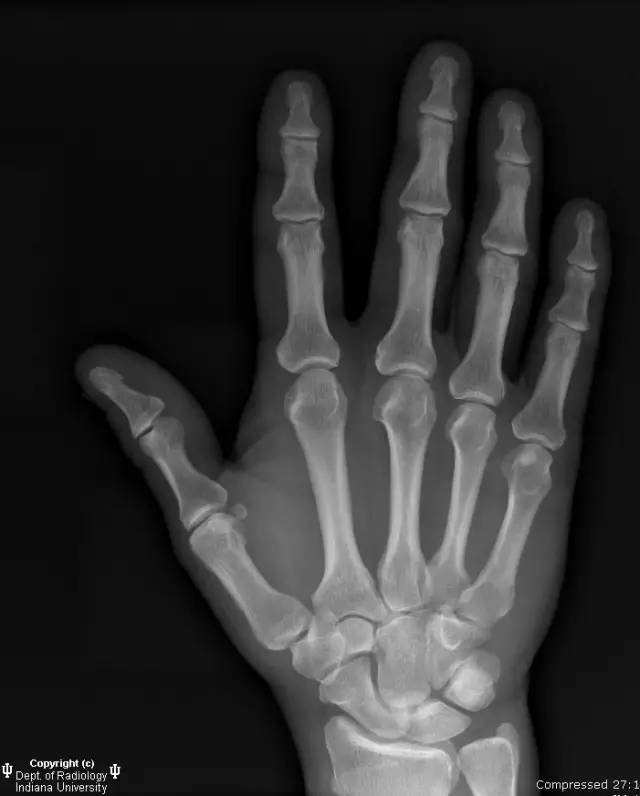 【病例】月骨缺血性坏死1例MR影像表现 【病例】月骨缺血性坏死1例MR影像表现