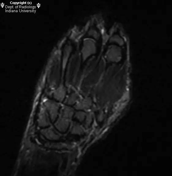 【病例】月骨缺血性坏死1例MR影像表现 【病例】月骨缺血性坏死1例MR影像表现