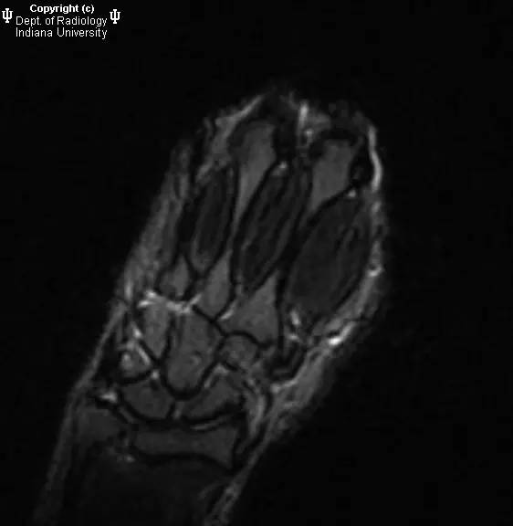 【病例】月骨缺血性坏死1例MR影像表现 【病例】月骨缺血性坏死1例MR影像表现