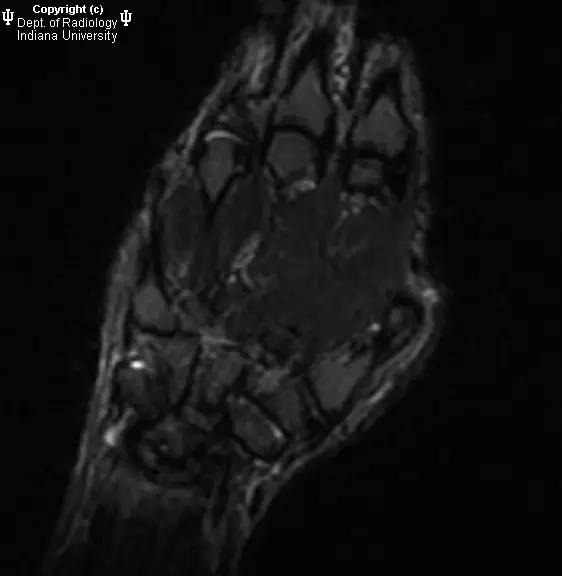【病例】月骨缺血性坏死1例MR影像表现 【病例】月骨缺血性坏死1例MR影像表现