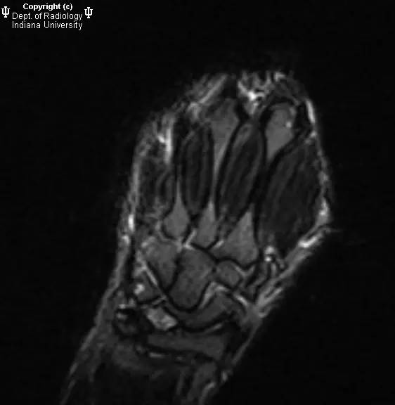 【病例】月骨缺血性坏死1例MR影像表现