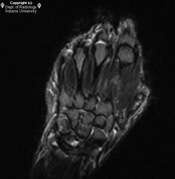 【病例】月骨缺血性坏死1例MR影像表现 【病例】月骨缺血性坏死1例MR影像表现