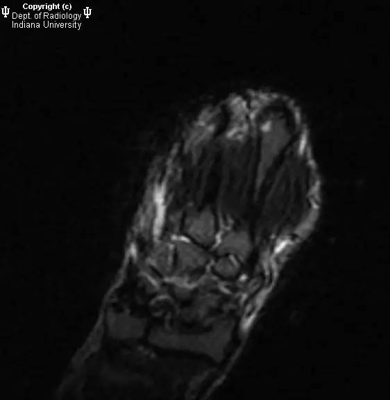 【病例】月骨缺血性坏死1例MR影像表现 【病例】月骨缺血性坏死1例MR影像表现
