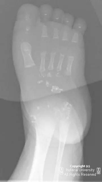 【病例】点状软骨发育不良1例X线影像表现 【病例】点状软骨发育不良1例X线影像表现