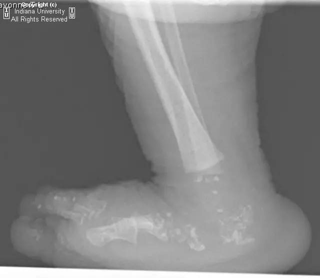 【病例】点状软骨发育不良1例X线影像表现 【病例】点状软骨发育不良1例X线影像表现