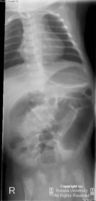 【病例】点状软骨发育不良1例X线影像表现 【病例】点状软骨发育不良1例X线影像表现