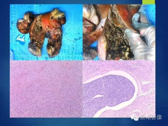【病例】子宫内膜间质肉瘤1例MR病例讨论