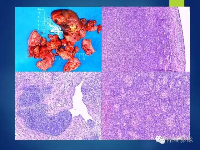 【病例】子宫内膜间质肉瘤1例MR病例讨论