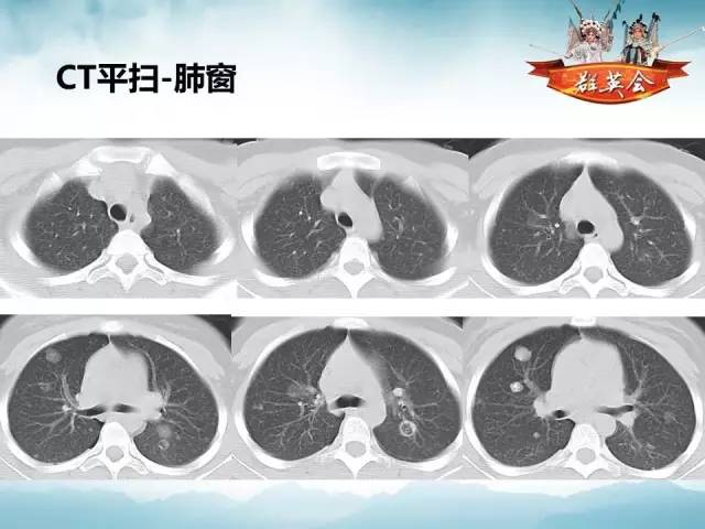 【病例】肺部结节性硬化1例CT影像表现