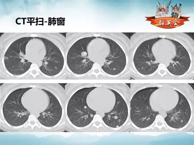 【病例】肺部结节性硬化1例CT影像表现