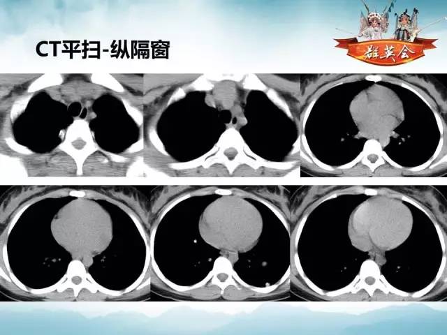 【病例】肺部结节性硬化1例CT影像表现