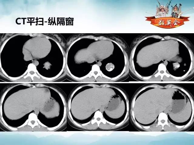 【病例】肺部结节性硬化1例CT影像表现