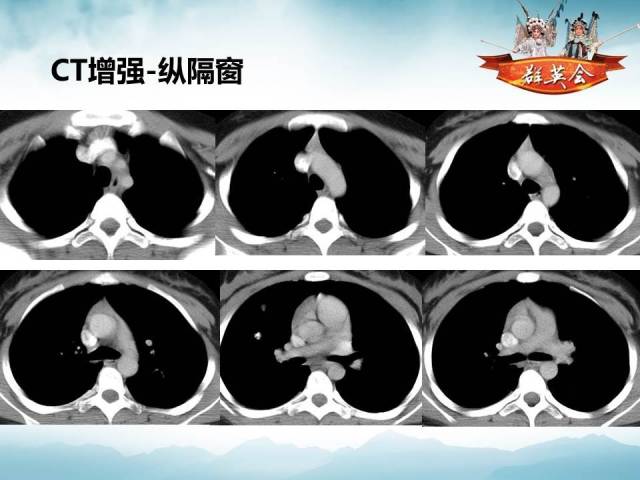 【病例】肺部结节性硬化1例CT影像表现