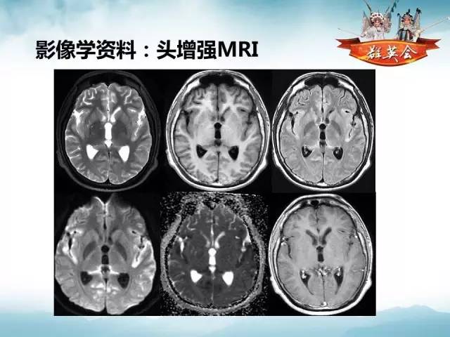 【病例】软脑膜原发性中枢神经系统肿瘤1例MR