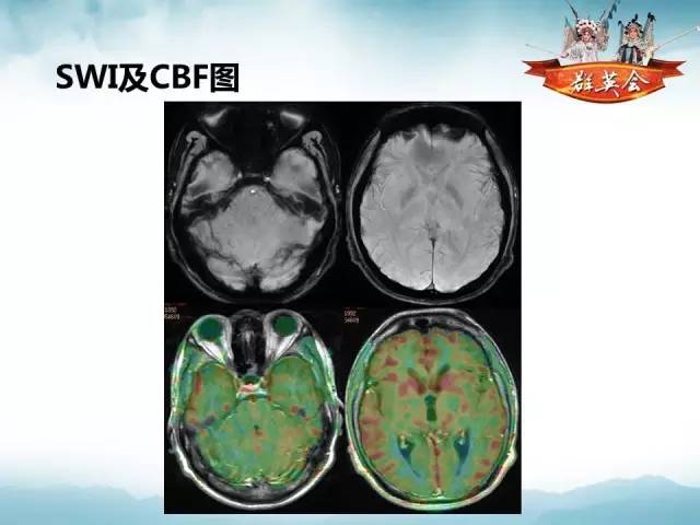 【病例】软脑膜原发性中枢神经系统肿瘤1例MR