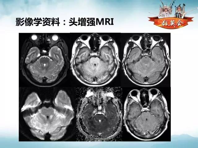 【病例】软脑膜原发性中枢神经系统肿瘤1例MR