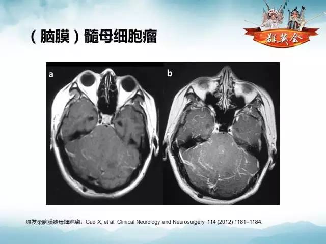 【病例】软脑膜原发性中枢神经系统肿瘤1例MR