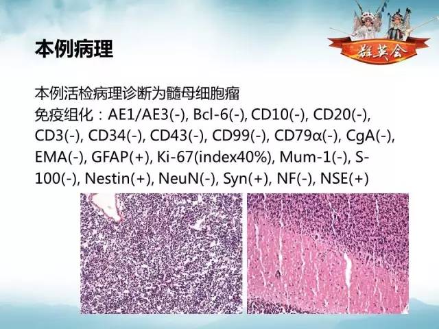 【病例】软脑膜原发性中枢神经系统肿瘤1例MR