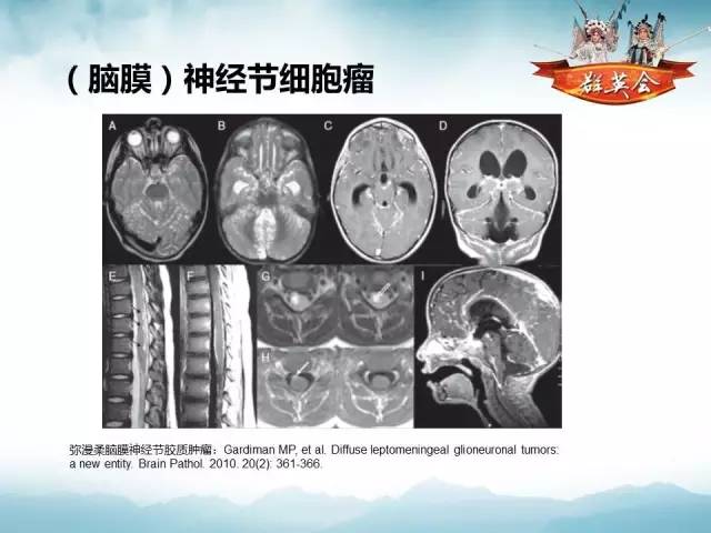 【病例】软脑膜原发性中枢神经系统肿瘤1例MR