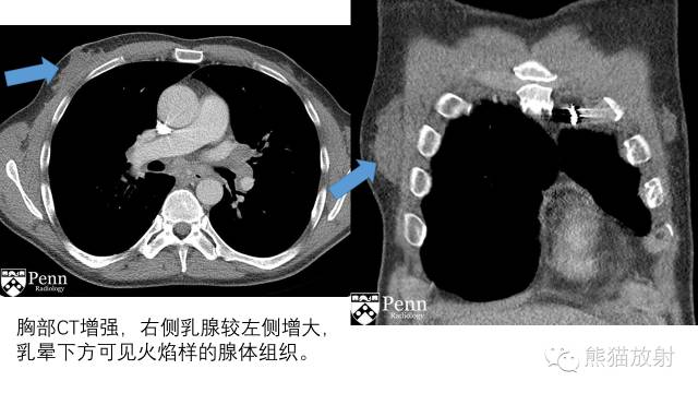 【病例】男性乳房发育症1例X线及CT影像表现 【病例】男性乳房发育症1例X线及CT影像表现