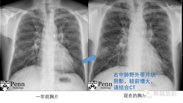 【病例】男性乳房发育症1例X线及CT影像表现 【病例】男性乳房发育症1例X线及CT影像表现
