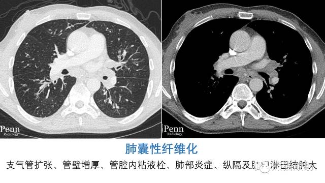 【病例】男性乳房发育症1例X线及CT影像表现 【病例】男性乳房发育症1例X线及CT影像表现