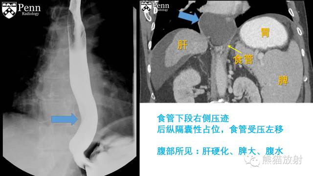 【双语病例】食管重复囊肿1例X线及CT影像表现 【双语病例】食管重复囊肿1例X线及CT影像表现
