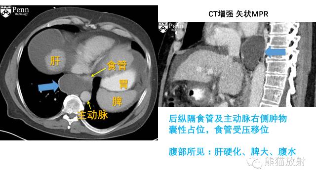 【双语病例】食管重复囊肿1例X线及CT影像表现 【双语病例】食管重复囊肿1例X线及CT影像表现