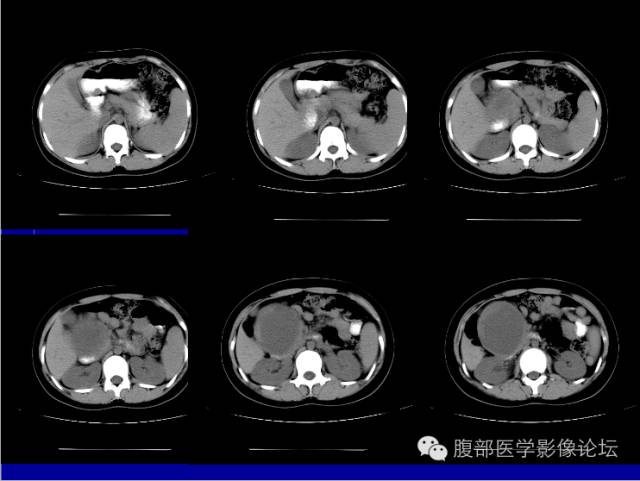 【病例】胰腺实性假乳头状瘤1例CT影像表现
