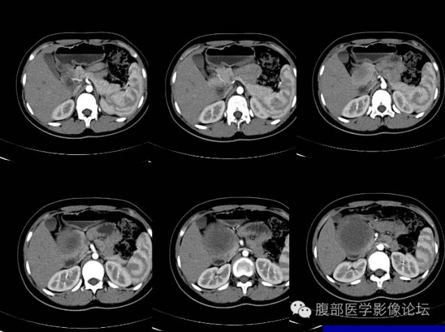 【病例】胰腺实性假乳头状瘤1例CT影像表现