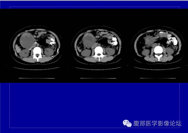【病例】胰腺实性假乳头状瘤1例CT影像表现