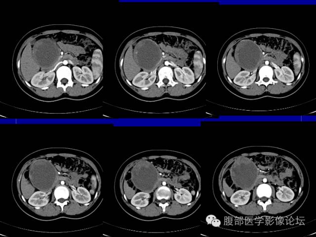 【病例】胰腺实性假乳头状瘤1例CT影像表现