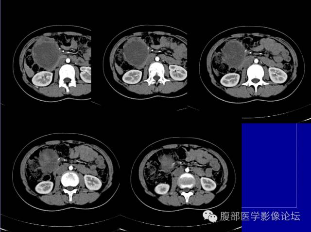 【病例】胰腺实性假乳头状瘤1例CT影像表现