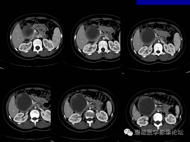 【病例】胰腺实性假乳头状瘤1例CT影像表现