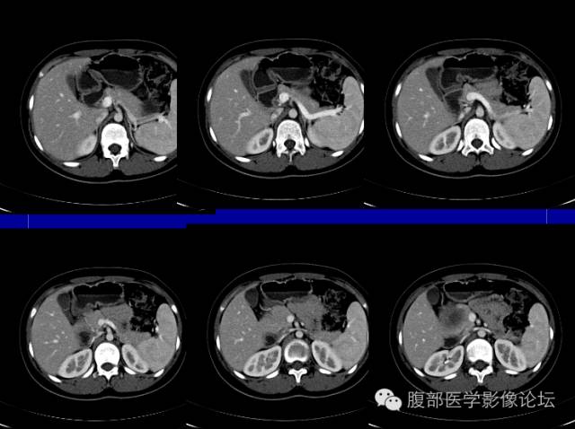 【病例】胰腺实性假乳头状瘤1例CT影像表现
