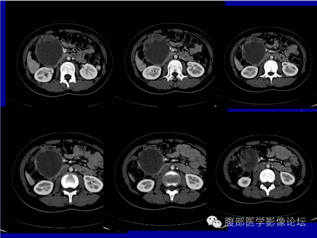 【病例】胰腺实性假乳头状瘤1例CT影像表现