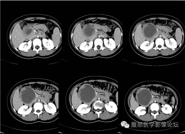 【病例】胰腺实性假乳头状瘤1例CT影像表现