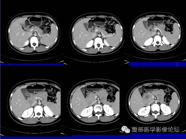【病例】胰腺实性假乳头状瘤1例CT影像表现