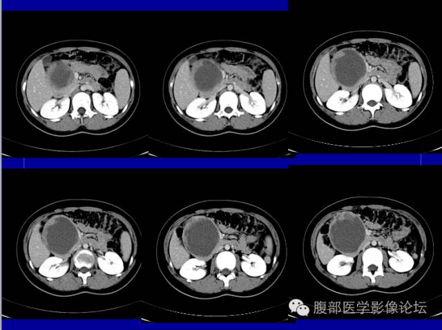 【病例】胰腺实性假乳头状瘤1例CT影像表现