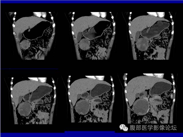 【病例】胰腺实性假乳头状瘤1例CT影像表现