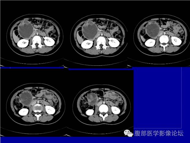 【病例】胰腺实性假乳头状瘤1例CT影像表现