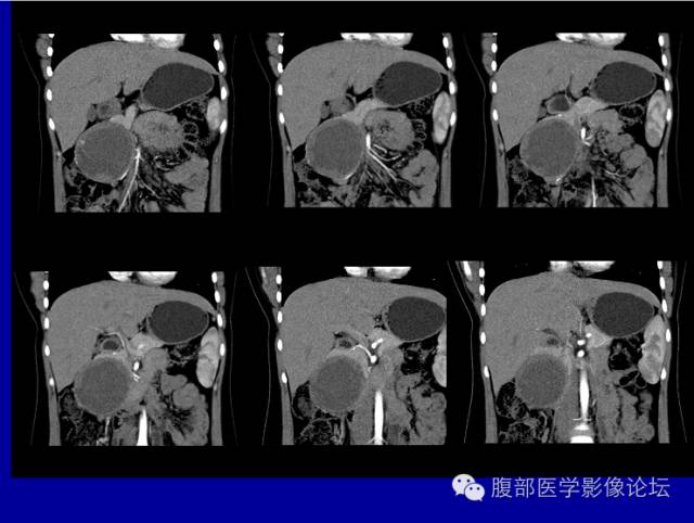 【病例】胰腺实性假乳头状瘤1例CT影像表现