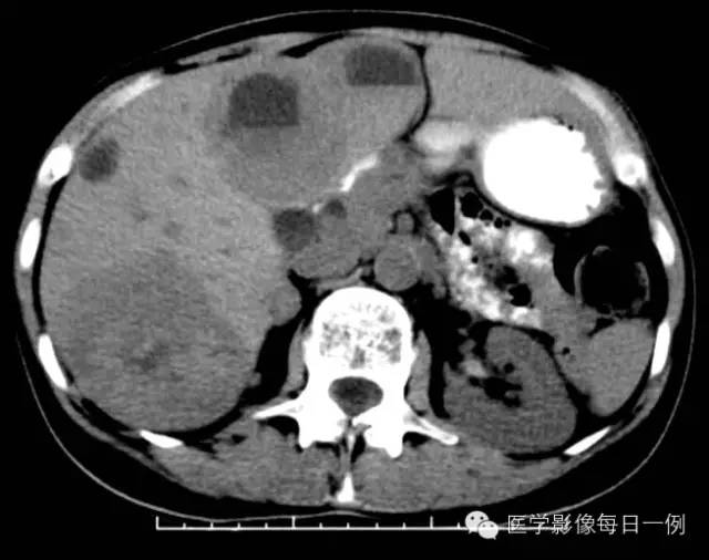 【病例】腹部类癌1例CT影像表现 【病例】腹部类癌1例CT影像表现