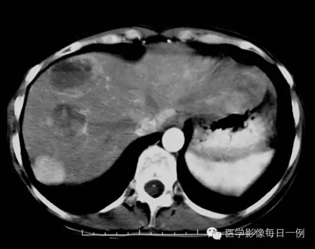【病例】腹部类癌1例CT影像表现 【病例】腹部类癌1例CT影像表现