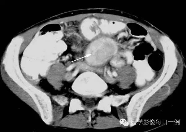 【病例】腹部类癌1例CT影像表现