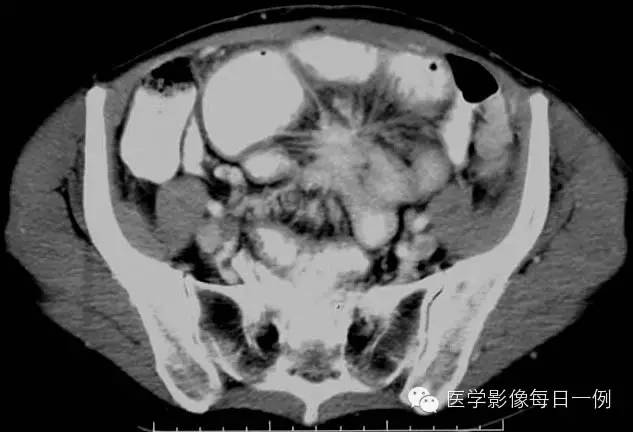 【病例】腹部类癌1例CT影像表现 【病例】腹部类癌1例CT影像表现